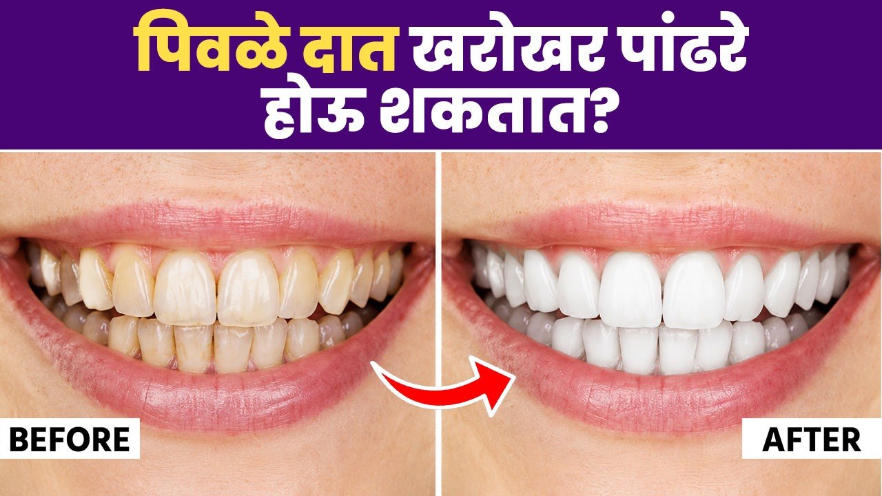 पिवळे दात खरोखर पांढरे होऊ शकतात? | Yellow teeth can actually become whiter? | Lokmat Sakhi