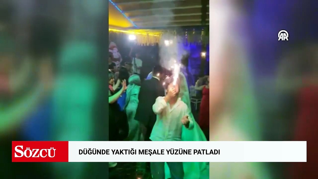 Düğünde yaktığı meşale yüzüne patladı