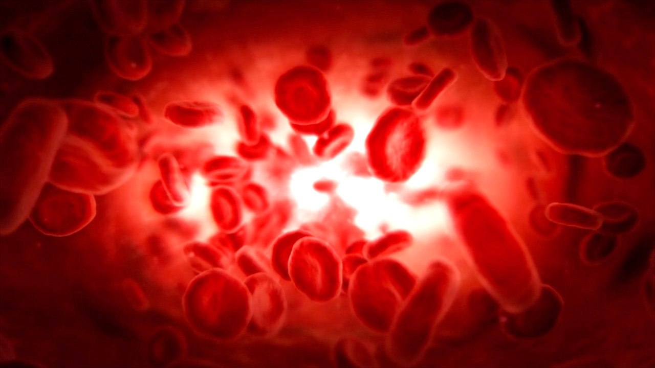 Microplastics Found in Most Arterial Plaques, Study Finds