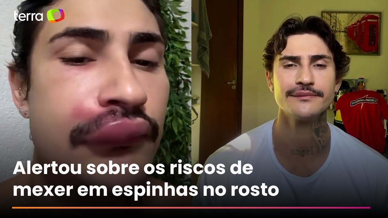 Influenciador ‘Ken de CG’ é internado após espremer espinha no rosto: ‘Meu rosto ficou assim’