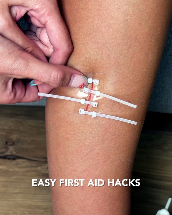 Helpful first aid hacks