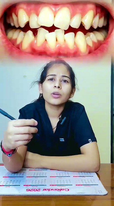 Veneers क्या होते हैं? 😲 Hollywood Smile का राज...