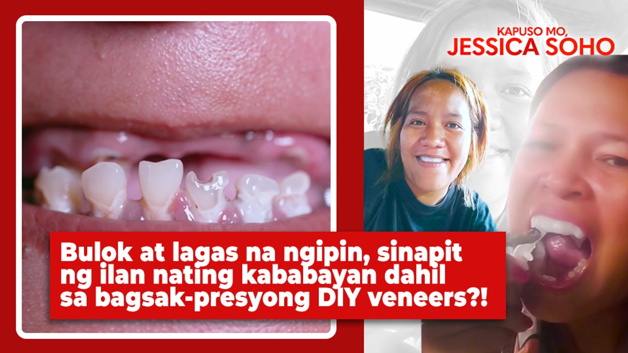 Bulok at lagas na ngipin, sinapit dahil sa bagsak-presyong DIY veneers?! | Kapuso Mo, Jessica Soho