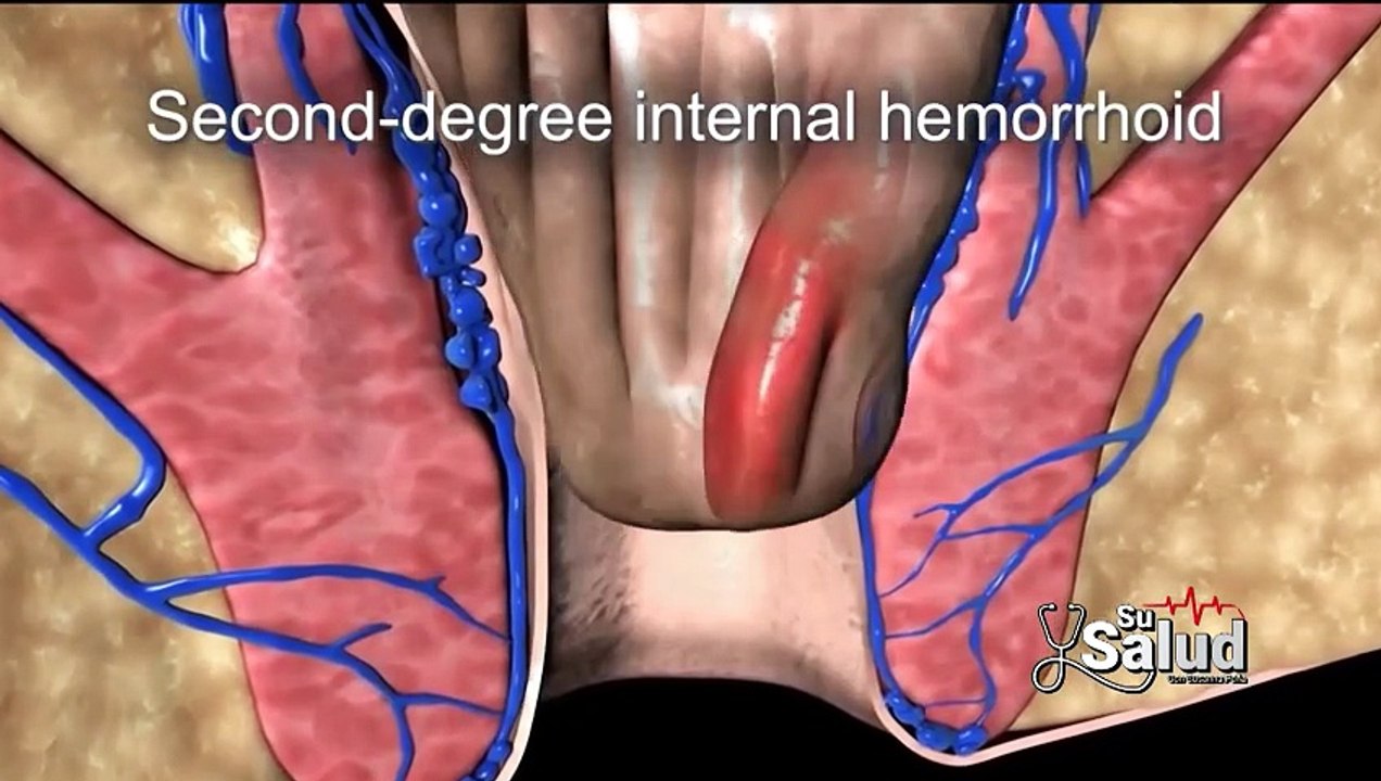 Su Salud: Causas y tratamientos de las hemorroides [Full Movie]