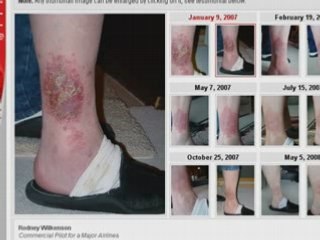 Shielding Skin Care Lotion Heals Chronic Eczema