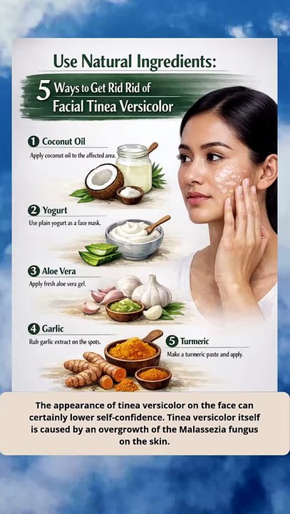 Using Natural Ingredients, Here Are 5 Ways to Get Rid of Tinea Versicolor on Your Face