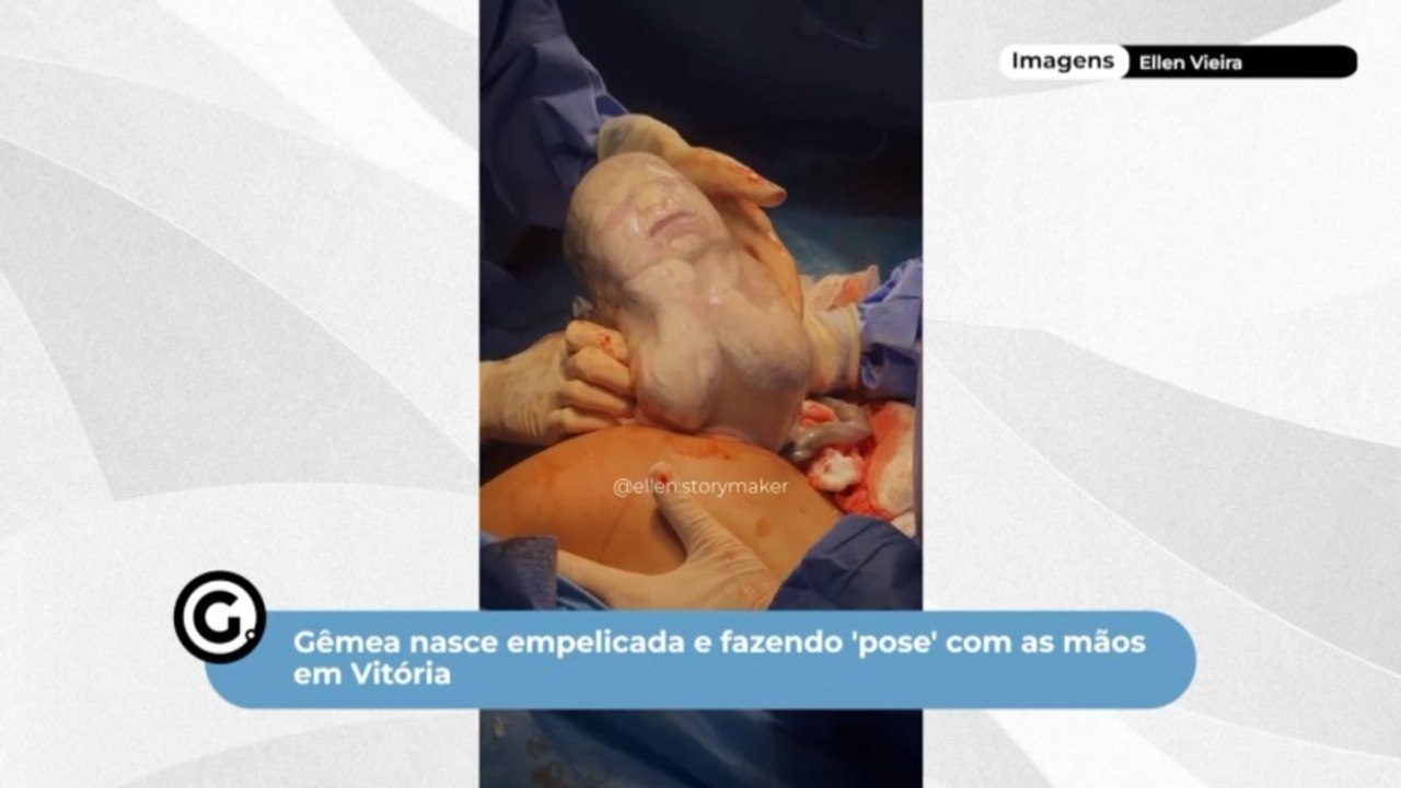 Gêmea nasce empelicada e fazendo 'pose' com as mãos em Vitória