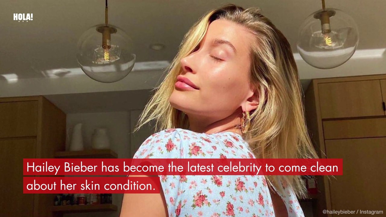 Hailey Bieber opens up about her skin condition