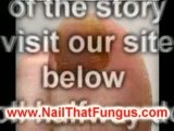 Treating Nail Fungus. My personal story...