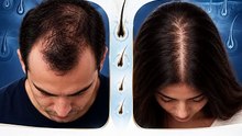 Male Pattern Baldness vs Female Pattern Hair Loss | Hair Loss Awareness | Certiderma