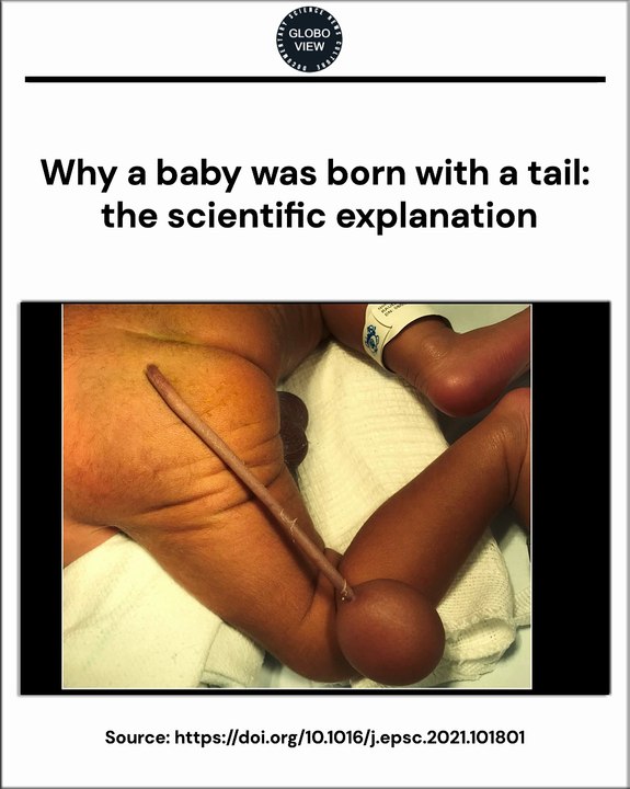 Why a baby was born with a tail: the scientific...