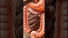 How Constipation Happens Inside Your Body | 3D Animation