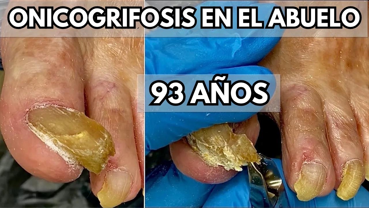 ¡Uñas engrosadas y amarillas! Increíble transfo...