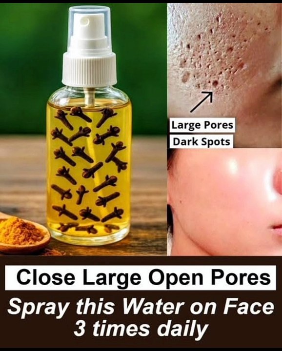 Natural Clove Spray to Close Large Open Pores & Remove Dark Spots at Home
