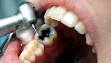 Teeth cleaning video