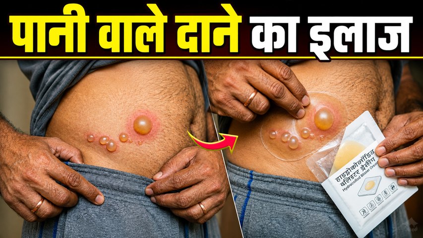 Water Blisters Treatment At Home: पानी वाले दाने का इलाज,फुंसी क्यों होती है | Boldsky