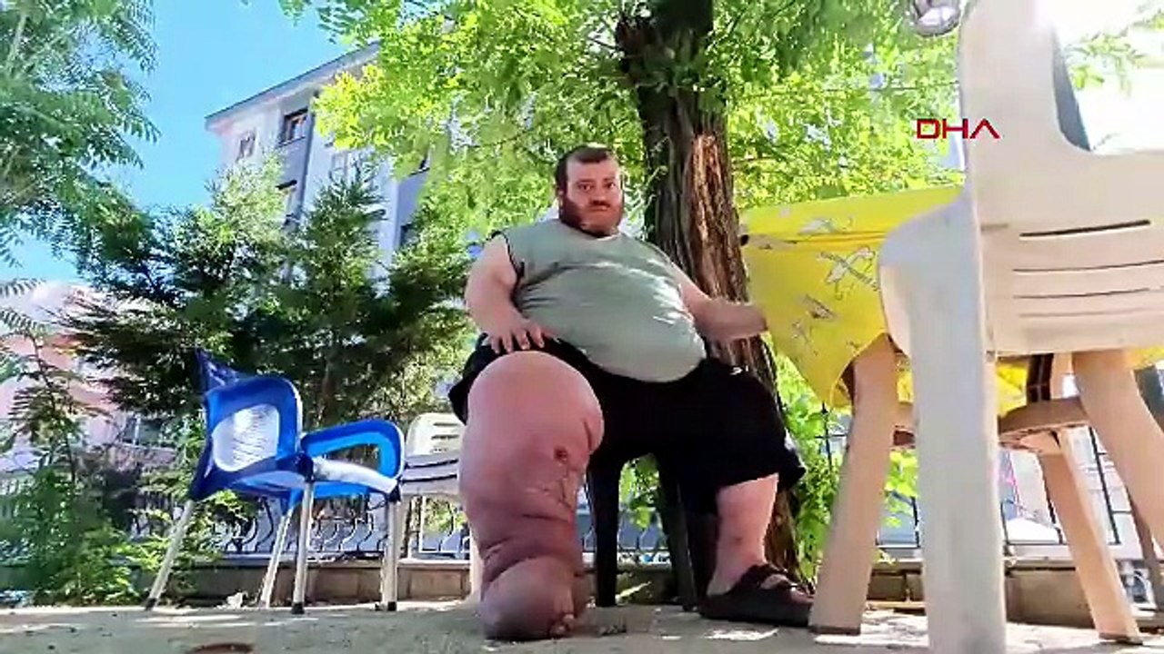 172 kiloluk fil hastasının zorlu mücadelesi: Tedavi olabilmek için 82 kilo vermek zorunda