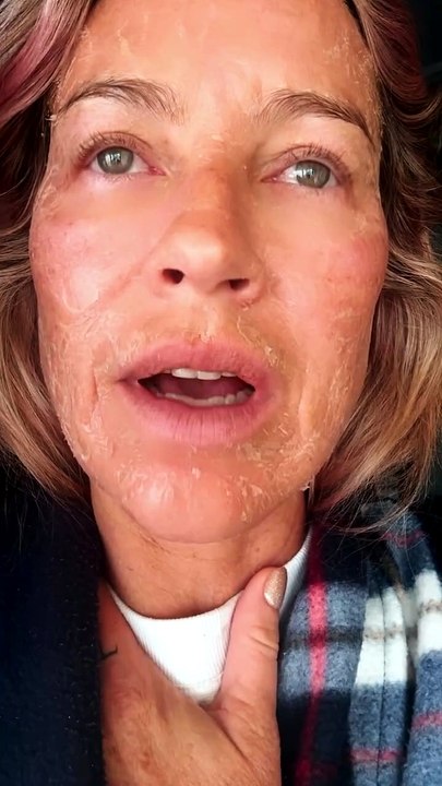 Luana Piovani explica mudança na pele após procedimento estético: "Carinha de 100 anos"