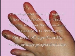 Do You Have Toxic Mold Candida?