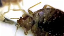 Can bed bugs live in your hair