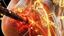 🦠 Can a Rusty Nail Really Cause Tetanus?