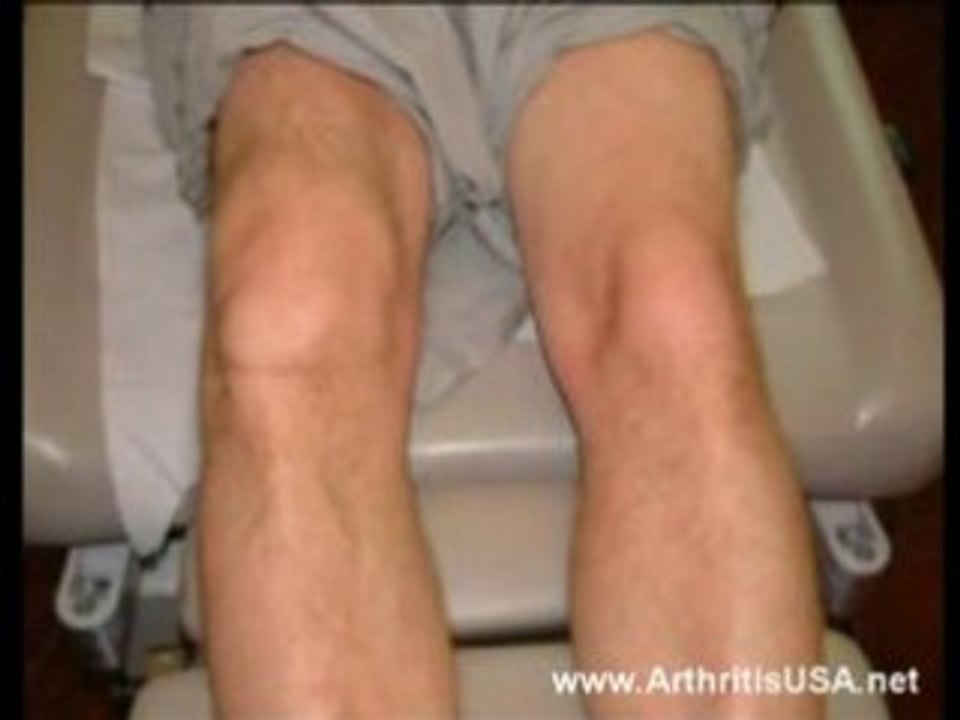 Dr Farshchian s Regenerative Medicine and Edema of  Knees