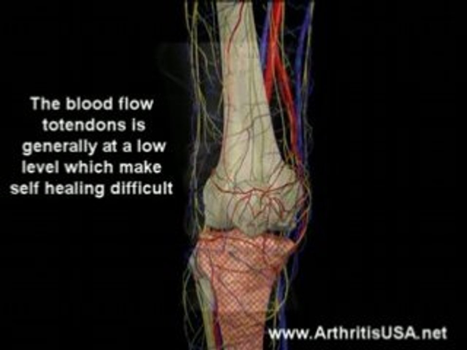 Dr Farshchian s Regenerative Medicine and Jumper's Knee