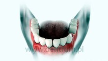 Implant zęba
