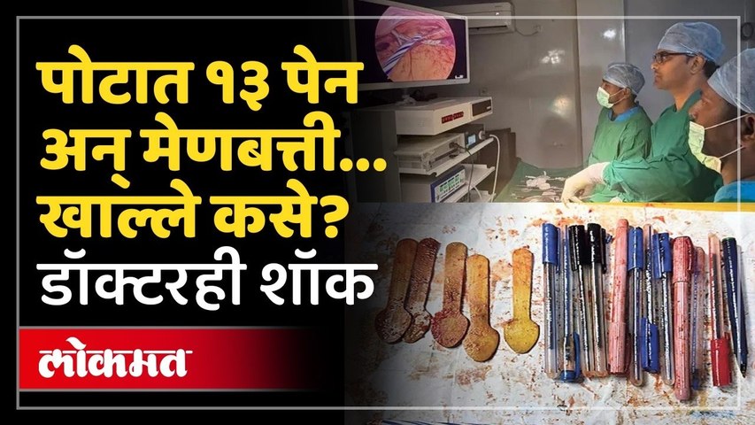 १३ पेन आणि मेणबत्ती...पोटाचा X-Ray पाहून डॉक्टरही शॉक! 14 Pens & Candle Removed From Woman's Stomach