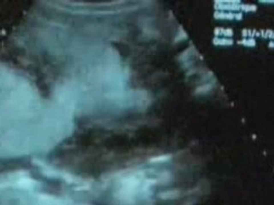 Echographie 2ème trimestre