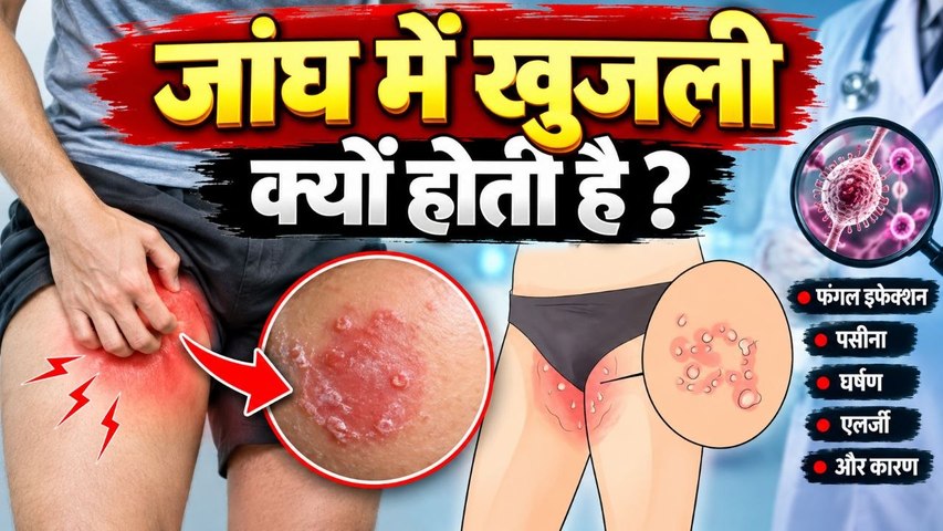 Thigh Ringworm Treatment: जांघ में दाद खाज खुजली क्यों होती है,कैसे ठीक करें |Home Remedy
