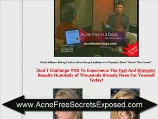 How To Be Acne Free Now