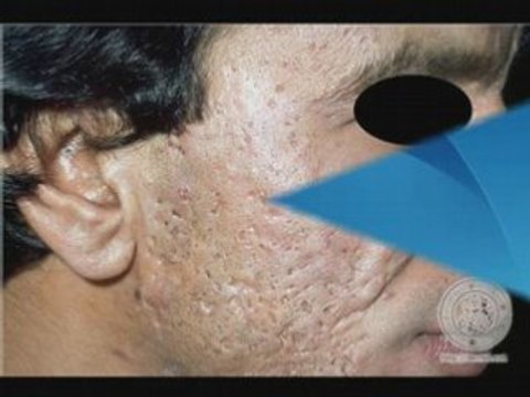 Acne Scarring Treatment