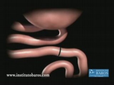 Bypass Gastrico. Cirugia de la Obesidad. Argentina.
