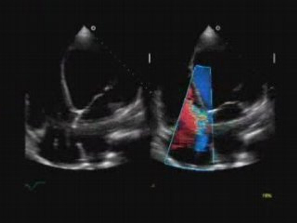 Insufficienza tricuspidale