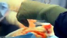 Liquid Steel Bleeding?