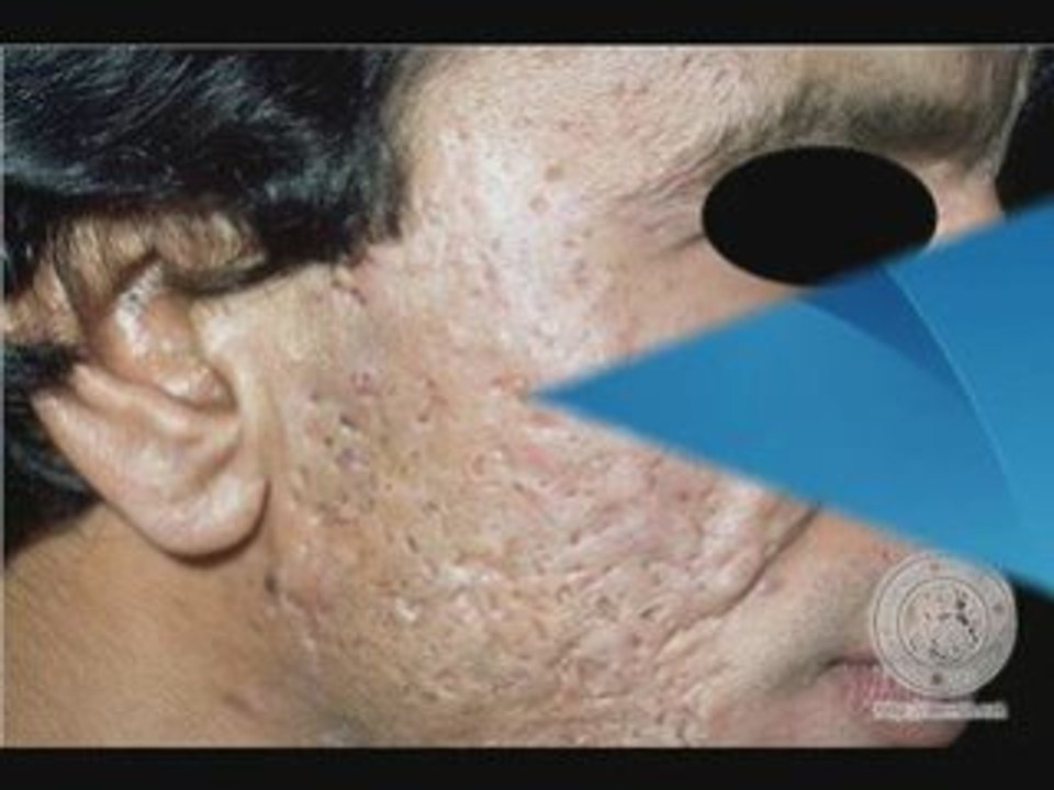Blemish Scar Video