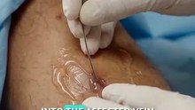Laser Treatment for Varicose Veins: What Actually Happens?