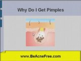 Why Do I Get Pimples?