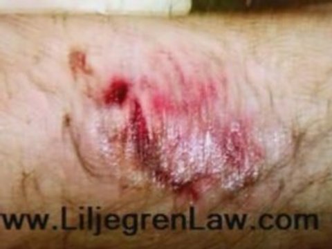 San Diego Escondido North County Personal Injury Lawyer