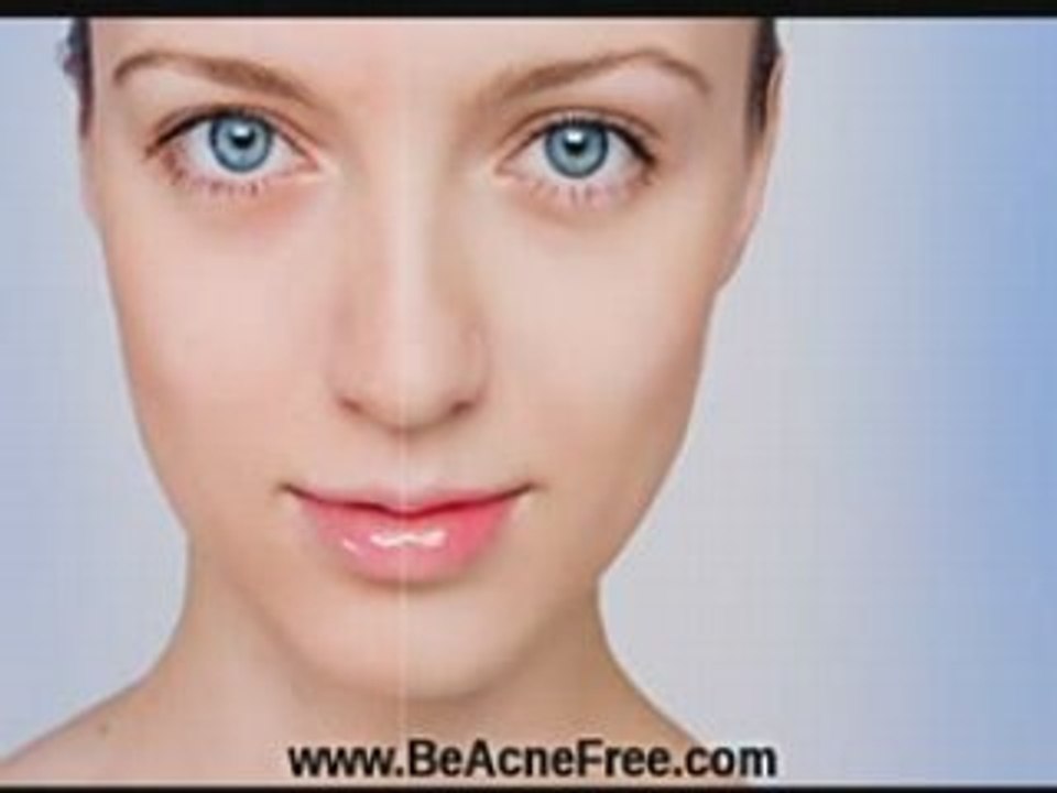 Does Toothpaste Work For Pimples?