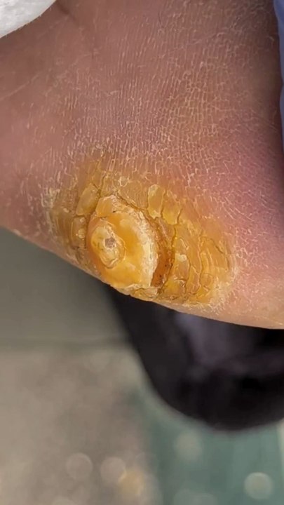 Huge Thick Calluses & Deep Corns on the Sole! | Professional Foot Care ...