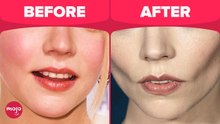 Top 10 Worst Cosmetic Surgery Trends Today