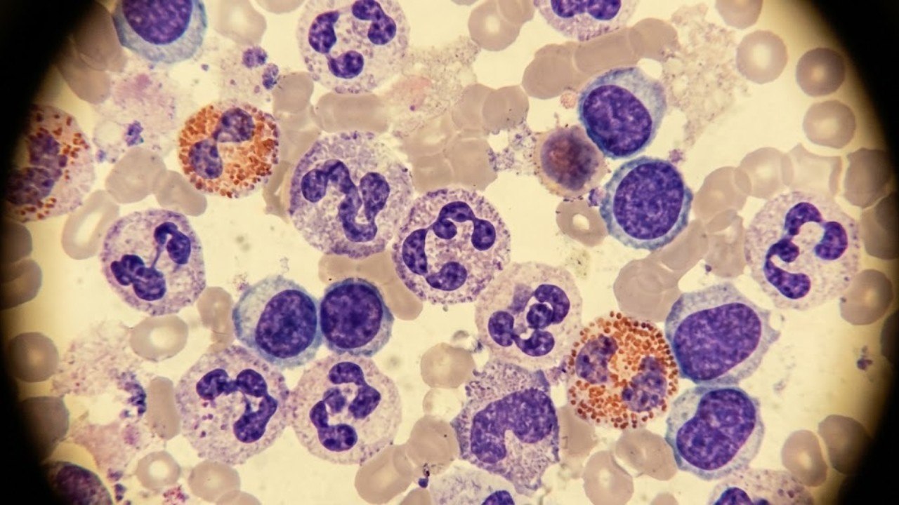 Study Maps 1 Million Immune Cells to Disease Risk - video Dailymotion