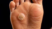 Painful Spot on Your Foot. It Could Be a Plantar Wart!