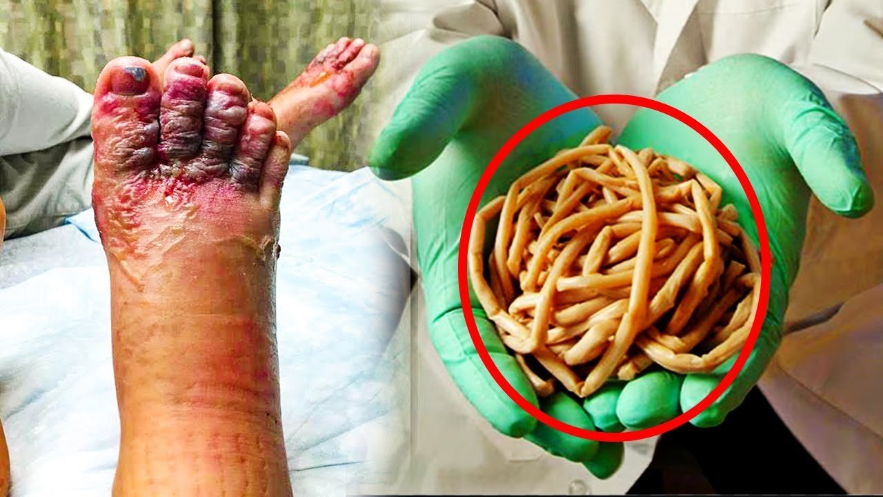 Parasites Burrow Into Couple’s Feet After Dominican Republic Beach Walk ...