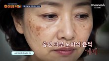 [예고] 중년 피부 노화의 흔적 기미! 치명적인 피부암 흑색종일 수 있다?
