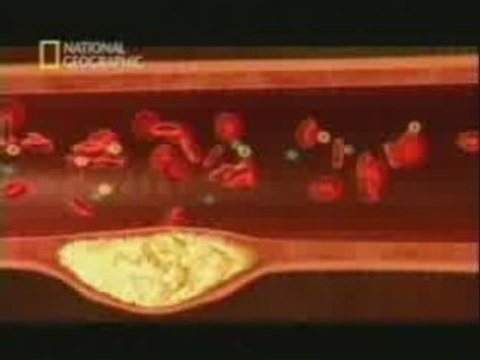 Infarto de miocardio: Factores de riesgo