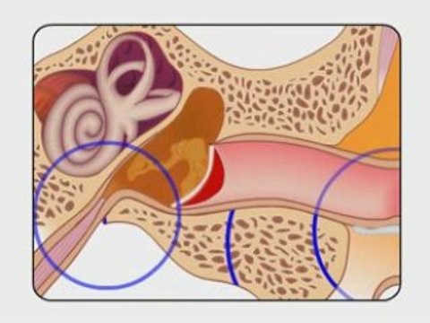 Ear infections and swimmers ear eardoc.info