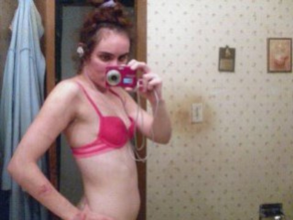 Anorexia Battles Countines:Today